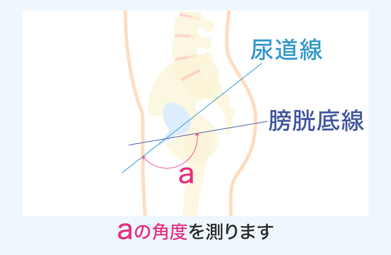 尿道線 膀胱底線 a aの角度を測ります