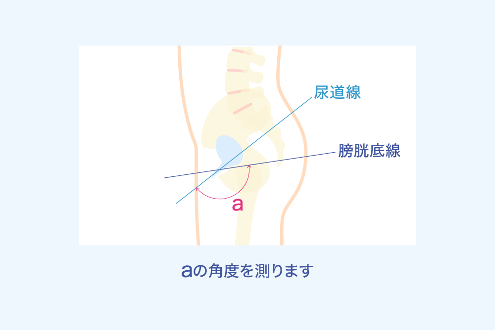 尿道線 膀胱底線 a aの角度を測ります